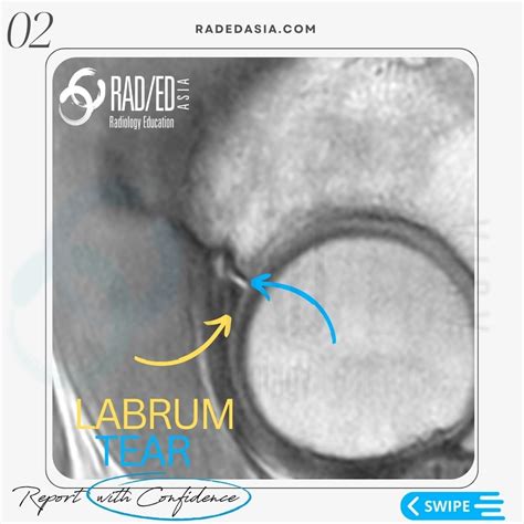 labral tear vs clicking sound